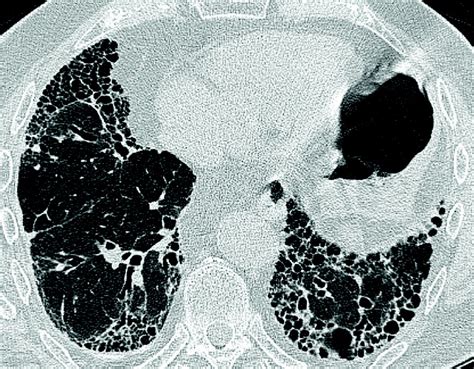 Idiopathic pulmonary fibrosis: a clinical update | British Journal of General Practice