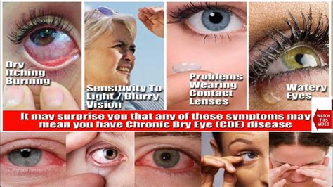 DRY EYE SYNDROME | हिंदी में | HINDI | Education & Information |Causes , Symptoms , Treatment ...