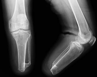 Transtibial Amputees - Gait Adaptations in Lower Limb Amputees