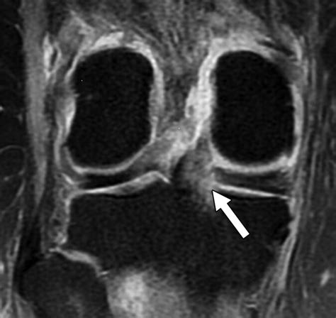 Meniscal Root Tears: An Update Focused on Preoperative and Postoperative MRI Findings | AJR