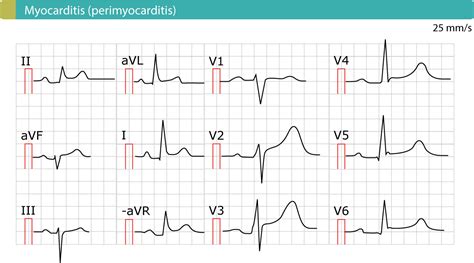 Pericarditis, myocarditis & perimyocarditis: ECG, criteria & treatment – Cardiovascular Education