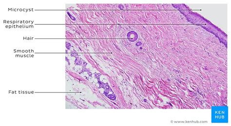 Ovarian torsion: Clinical case, presentation, diagnosis | Kenhub