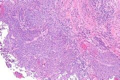 Nasopharyngeal carcinoma - Libre Pathology