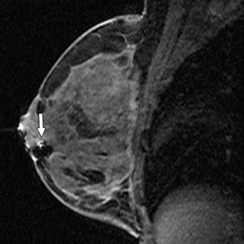 MR-guided breast biopsy results need careful correlation with histology ...