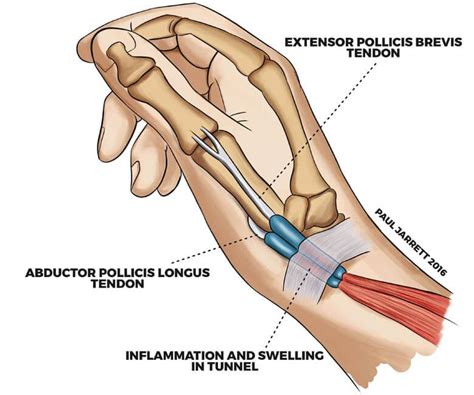 DeQuervain’s Tenosynovitis - Hand & Wrist Surgeon Perth