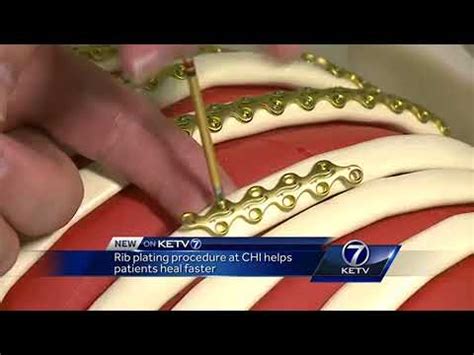 Rib plating procedure at CHI helps patients heal faster - YouTube