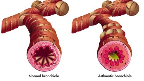 Methacholine Challenge Test - Procedure Details - Healthgrades.com