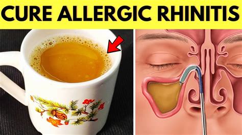 Cure Allergic Rhinitis Permanently and Naturally Using This Home Remedy ...