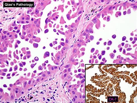 Bronchioloalveolar Carcinoma | Flickr