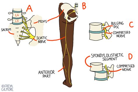 Osteopathy for Sciatica/Nerve & Disc Pain. Macclesfield & Knutsford ...