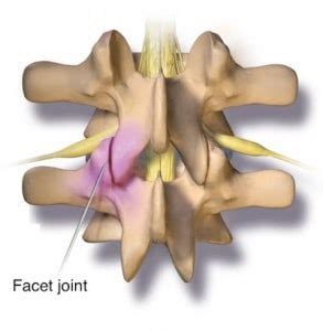 Synovial Cyst - Dr. Paul C. McCormick