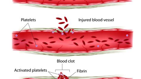 Hemostasis - Blood Vessel Injury - Injury Choices