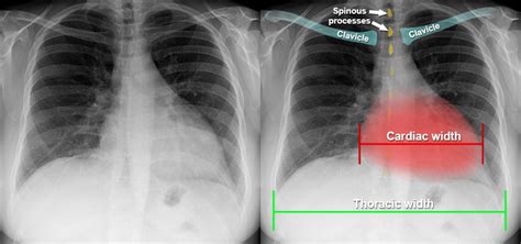 Chest X-ray - Cardiac disease - Cardiomegaly