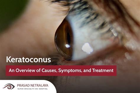 Keratoconus: An Overview of Causes, Symptoms and Treatments