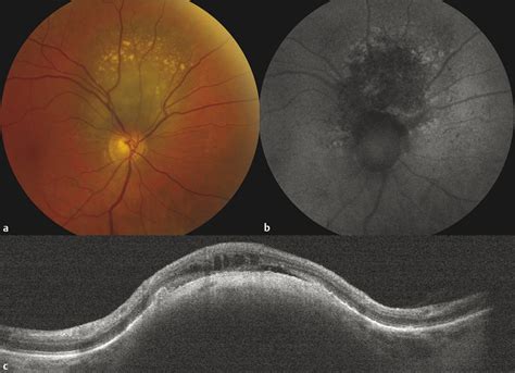 Choroidal Nevus | Ento Key