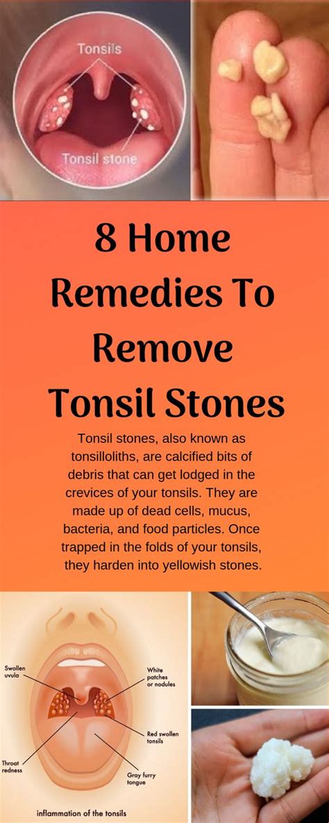 How To Remove Tonsil Stones With Cotton Swab - HOWOTREMVO