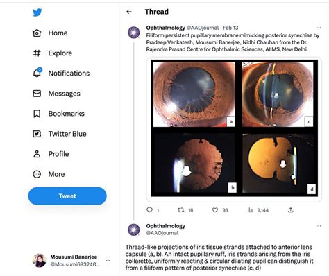 (PDF) Filiform persistent pupillary membrane mimicking posterior synechiae