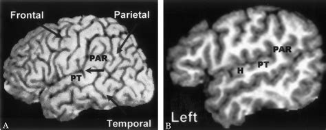 Anatomy of the planum temporale (PT). The PT is located along the... | Download Scientific Diagram