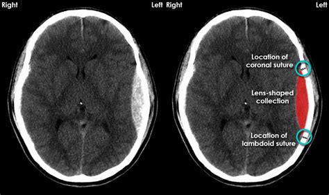 Ct Brain Hemorrhage Startradiology Radiologa