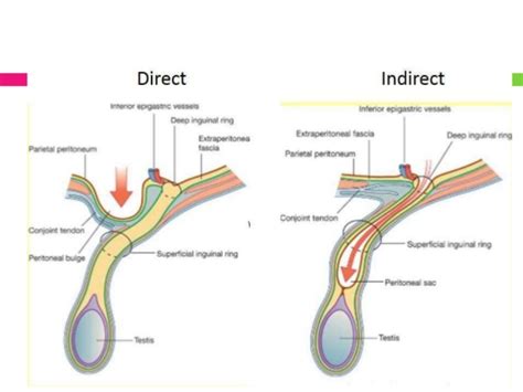 ANATOMY Of A HERNIA – Holistic Hernia Remediation