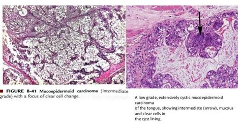 Mucoepidermoid carcinoma