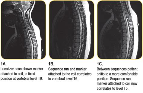 Best Practices for Establishing Vertebral Level on Thoracic Spine ...