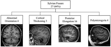 Spectrum of Sylvian fissure abnormalities in 27 patients. | Download ...