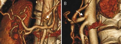 Median arcuate ligament syndrome, causes, symptoms, diagnosis, treatment & prognosis