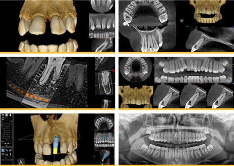 3D CT Scan Imaging for Dental Implant Surgery in Vancouver& Burnaby BC