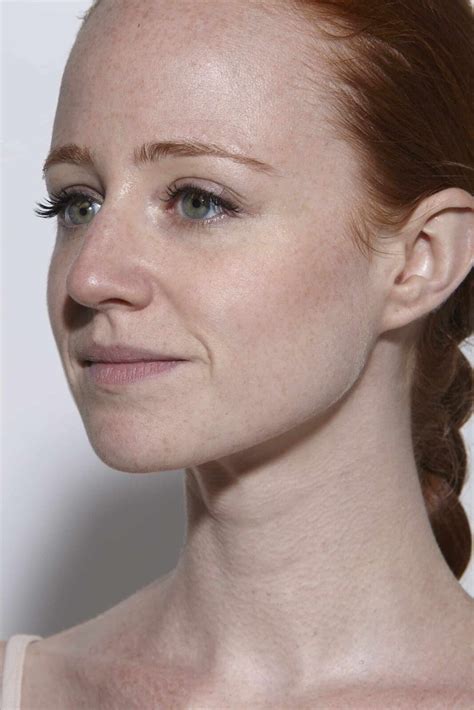 Did You Know Natural Redheads Have Couperose Skin?