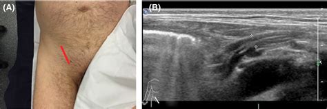 Evaluation of hernia of the male inguinal canal: sonographic method ...