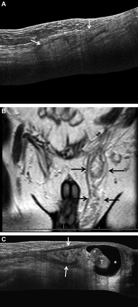 Spermatic cord lipomatosis. A-C, Two different cases with (A and B) and ...