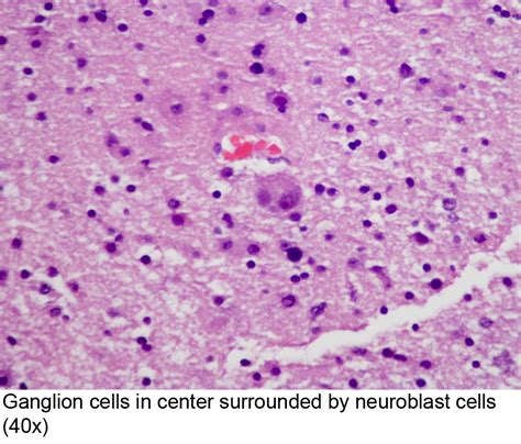 Ganglioneuroma Pathology Outlines