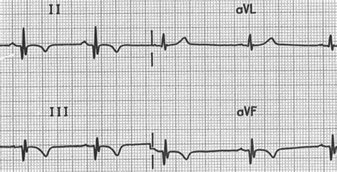 Q Wave • LITFL • ECG Library Basics