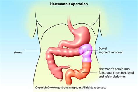 Hartmann operation - meddic