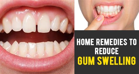 Home Remedies to Reduce Gum Swelling - Remedies Lore