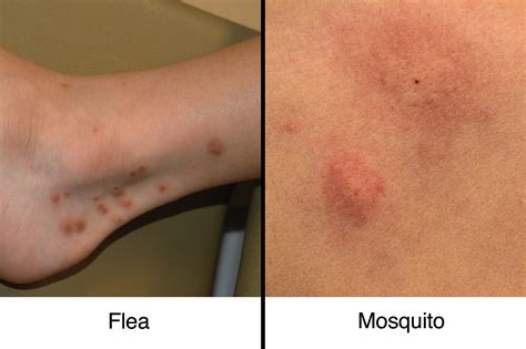 Fleabites vs. Mosquito Bites: How to Tell the Difference | The Healthy