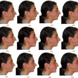 (PDF) Effects of different nose types on class II treatments for female patients