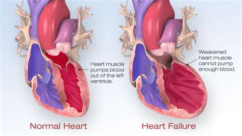 Cardiovascular Institute Offers Heart Failure Clinic | Cardiovascular Institute of Northwest Florida