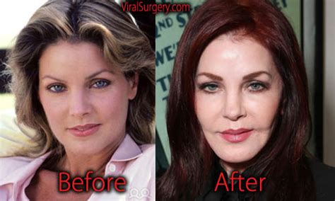 Priscilla Presley Plastic Surgery, Before and After Facelift Pictures