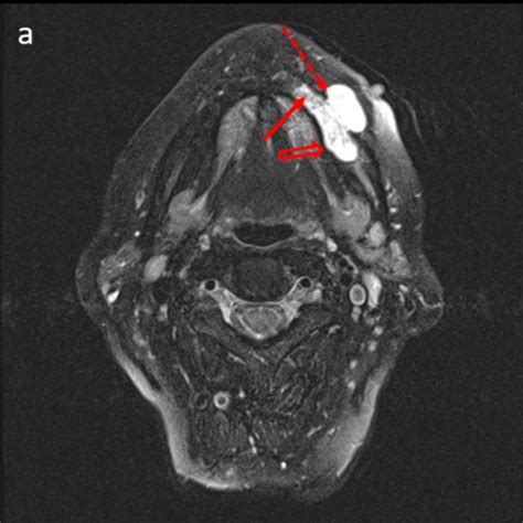 Odontogenic Keratocyst Radiology