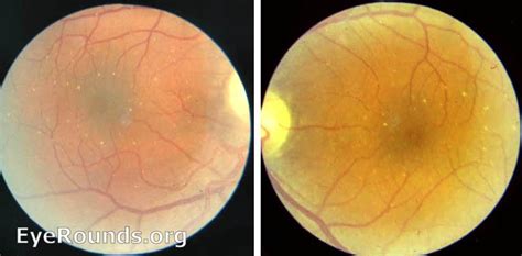 Talc retinopathy. EyeRounds.org: Online Ophthalmic Atlas