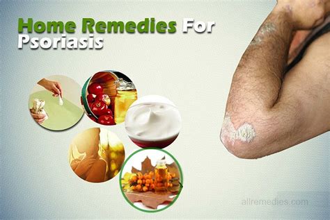Top 20 Natural Home Remedies for Psoriasis That Work