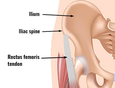 Rectus Femoris Tendon Strain - Symptoms, Causes, Treatment & Rehab