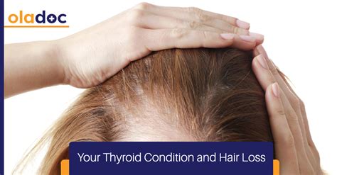 Your Thyroid Condition and Hair Loss | Thyroid Care | oladoc.com