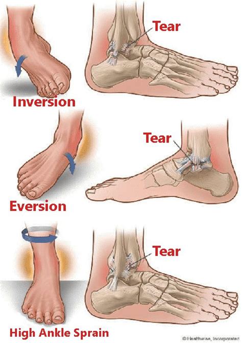 Ankle Sprains: How Physical Therapy Can Help!