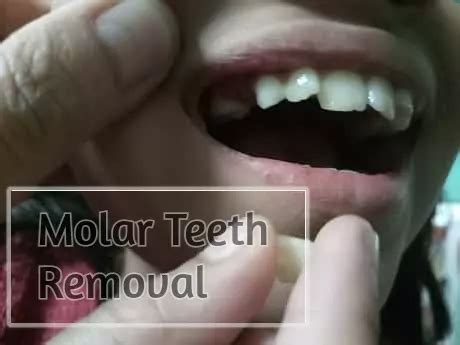 Molar Teeth Removal - What You Should Know