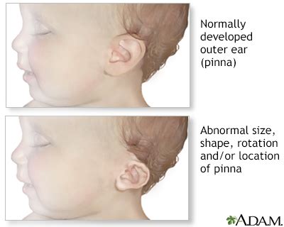 Low-set ears and pinna abnormalities