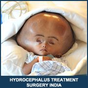 Hydrocephalus Treatment Surgery India