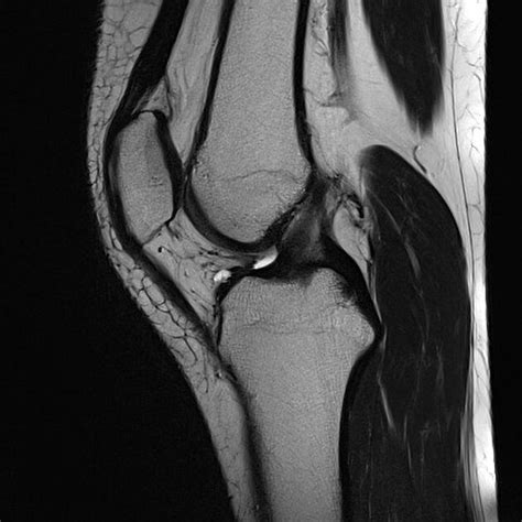 Mri Knee